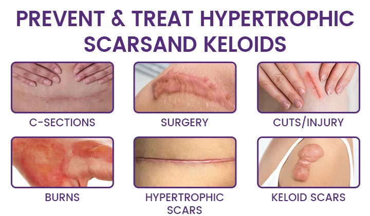 🔥 LIMITED SPECIAL OFFER Grunsify Scar Repair Gel