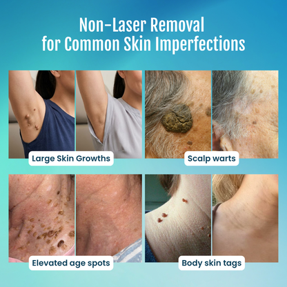 vellarocare® 7-Day Skin Tag & Blemish Repair Pen—a painless, scar-free, and highly effective blemish-removal roller pen.