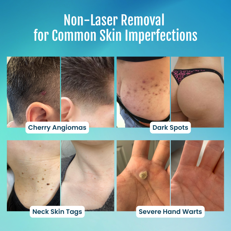 vellarocare® 7-Day Skin Tag & Blemish Repair Pen—a painless, scar-free, and highly effective blemish-removal roller pen.